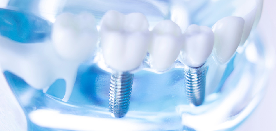 Zahnimplantate in Paderborn bei Ihrem Zahnarzt: für feste Zähne